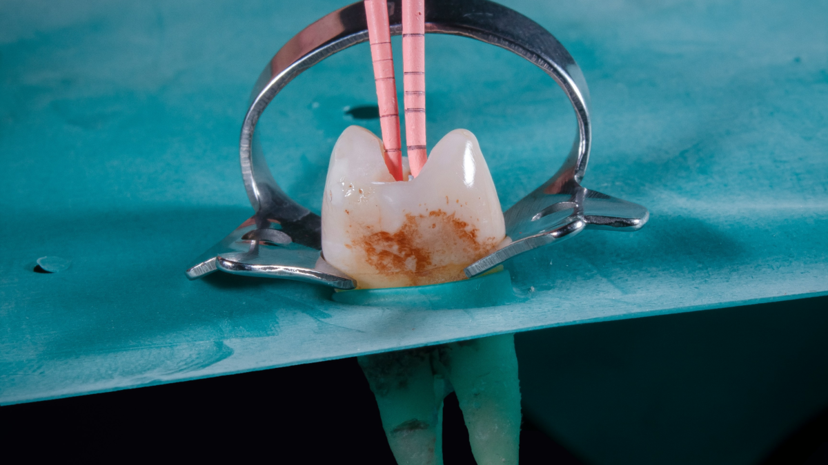 What Is Root Canal Treatment?
