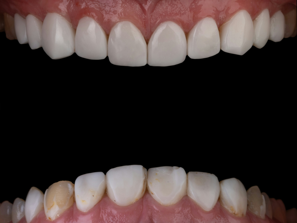 Gum Disease (Gingivitis & Periodontitis): Causes, Symptoms, and Treatment