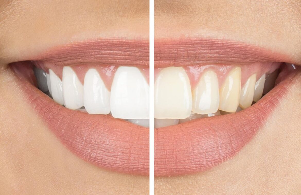 Teeth Whitening vs. Dental Veneers: Which is Right for You?