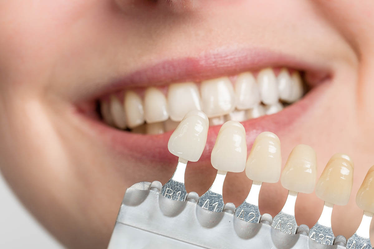 Discovering the Secrets Behind Dental Veneers: Beauty and Care Tips