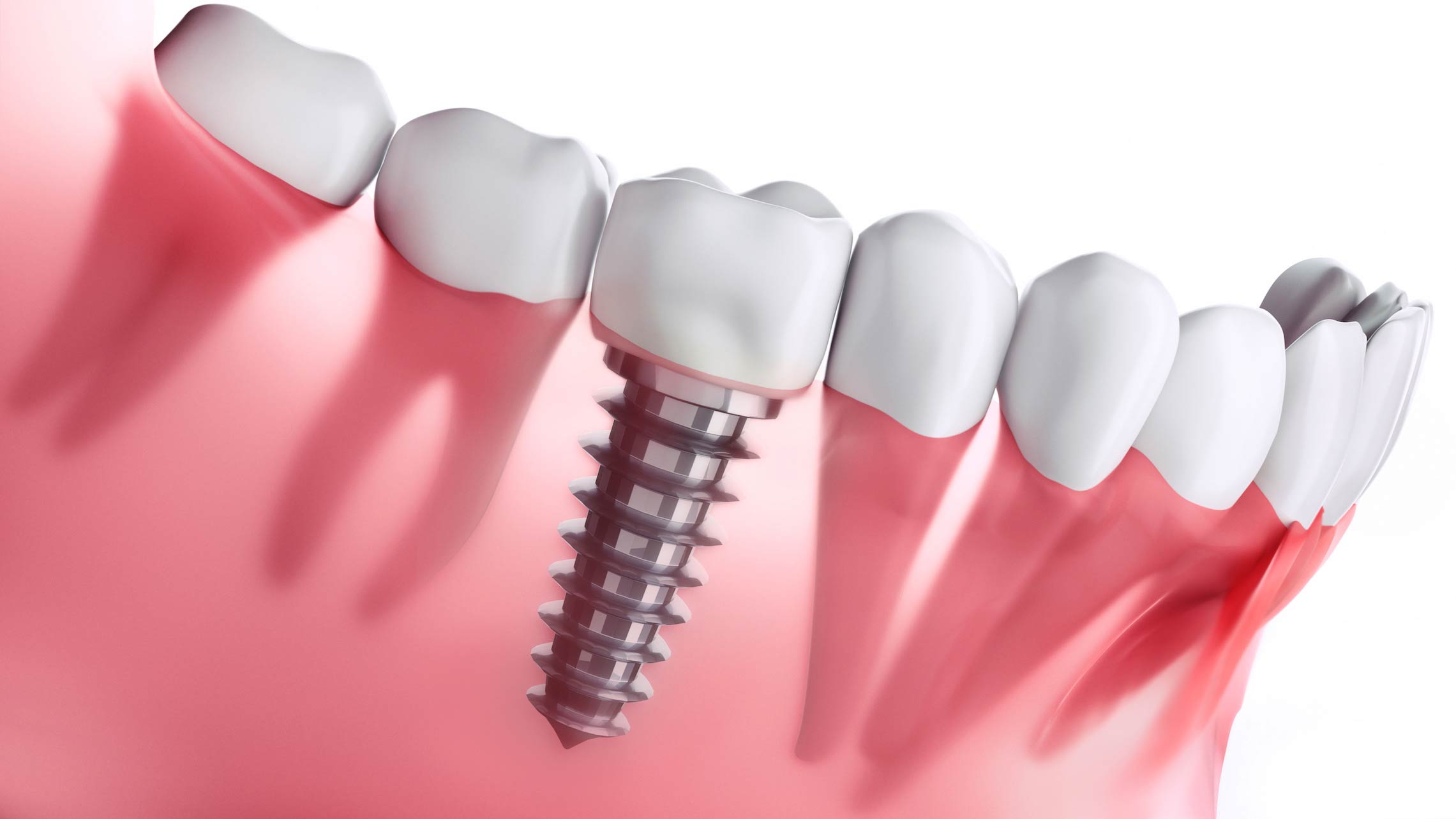 Choosing the Right Dentist for Your Dental Implants