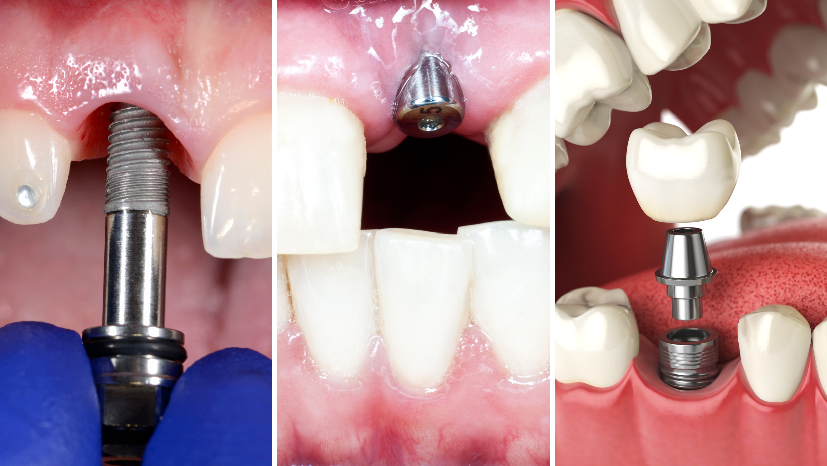 How to Care for Your Dental Implants: Tips for Long-lasting Results