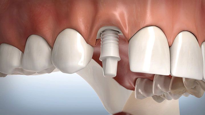 How Dental Implants Can Transform Your Smile and Confidence