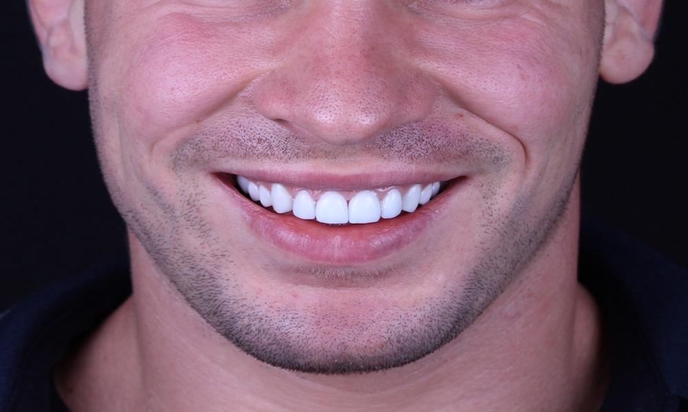 Everything You Need to Know About Dental Veneers for a Flawless Smile