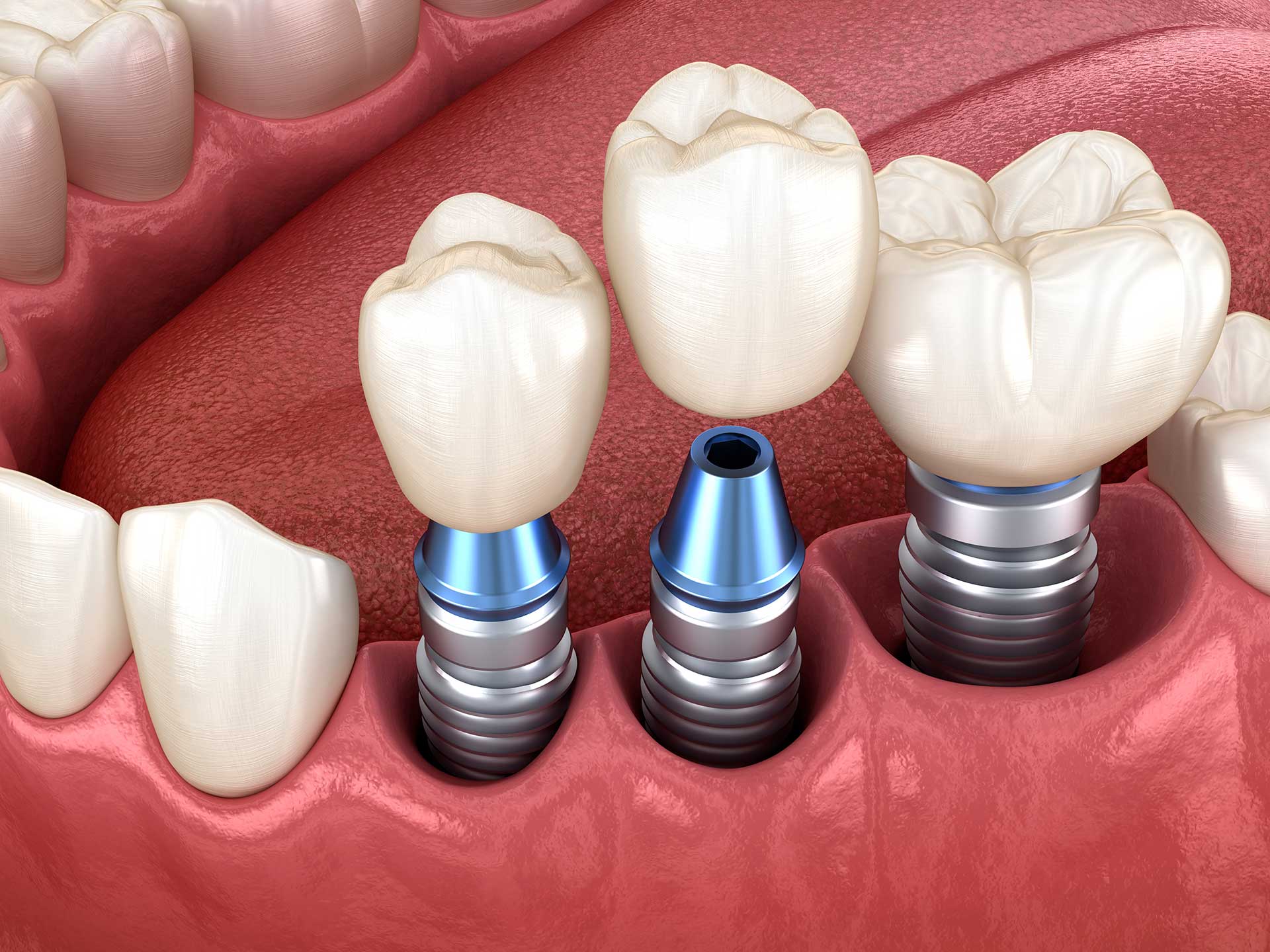 The Truth About Dental Implants: Achieve Your Dream Smile