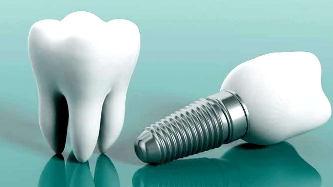 How to Choose the Right Dentist for Your Dental Implants